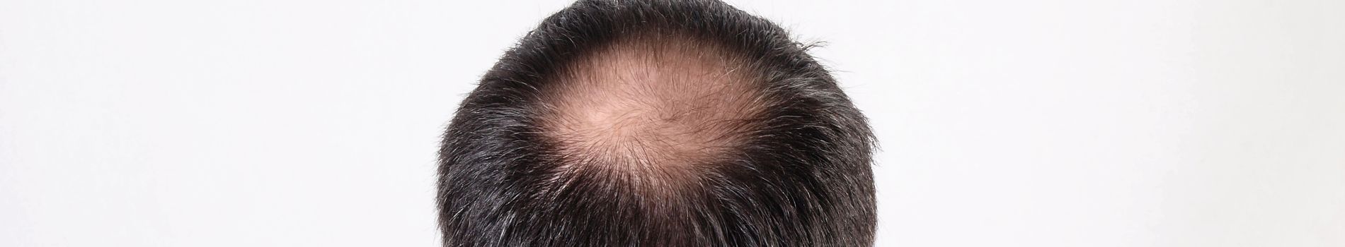 Does iodine affect hair loss